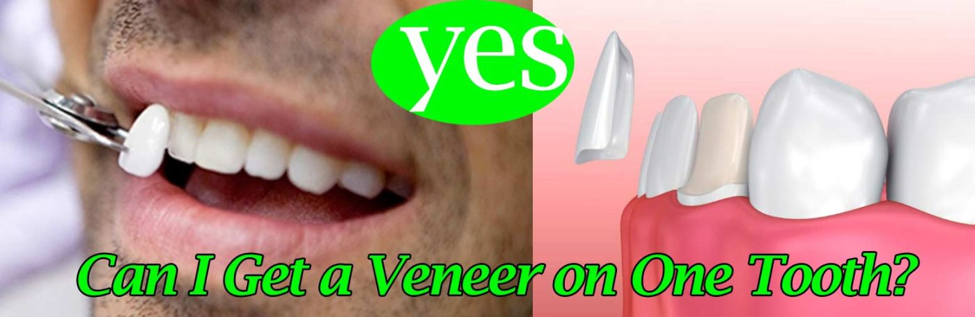 Can I Get a Veneer on One Tooth